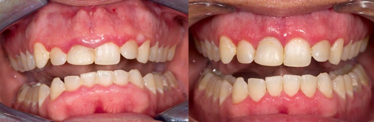 Clinical_Gemini_4_Weeks_Gingivectomy_Dr.J_8_20_18