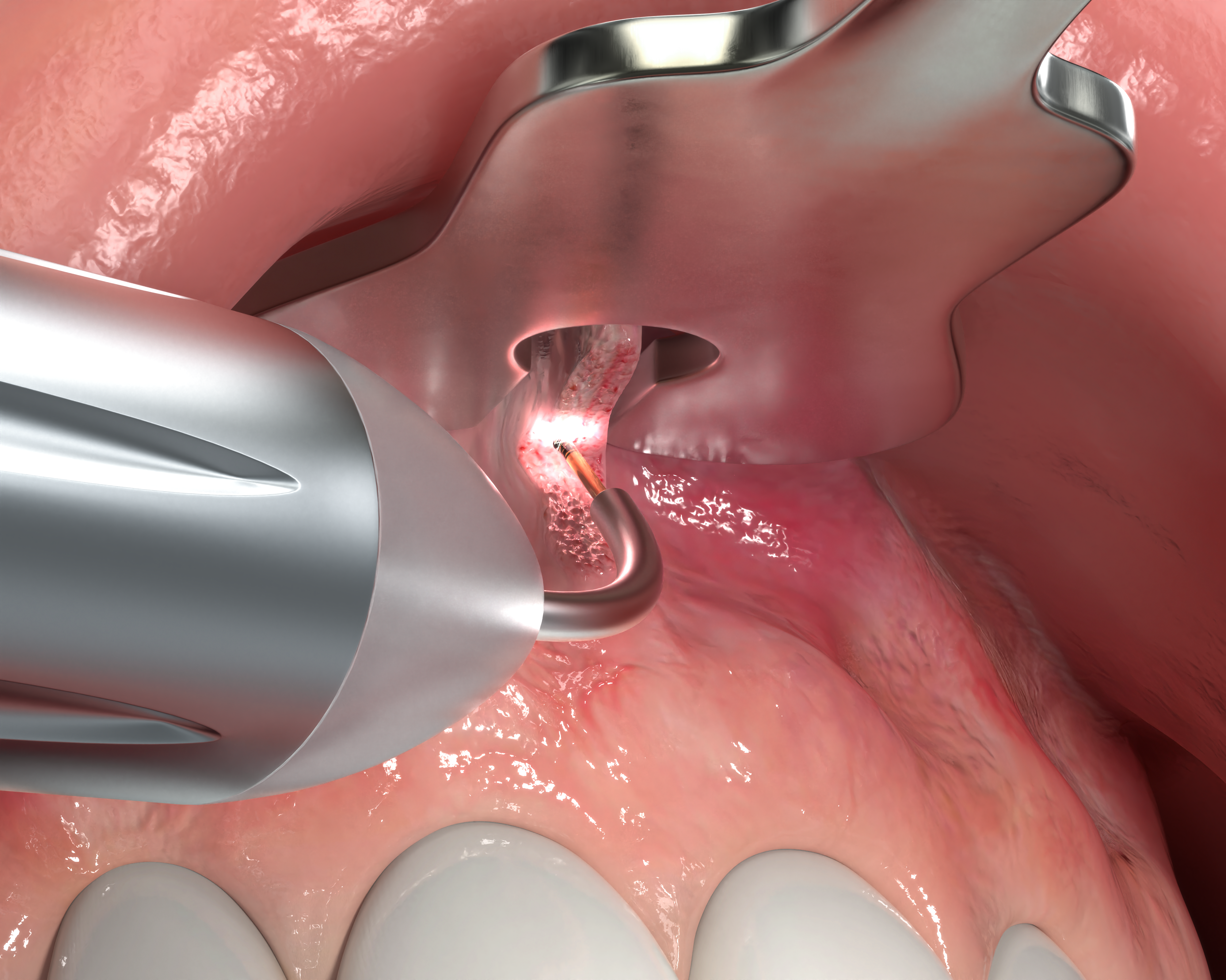 Frenectomy_Panel_4_3D_0825