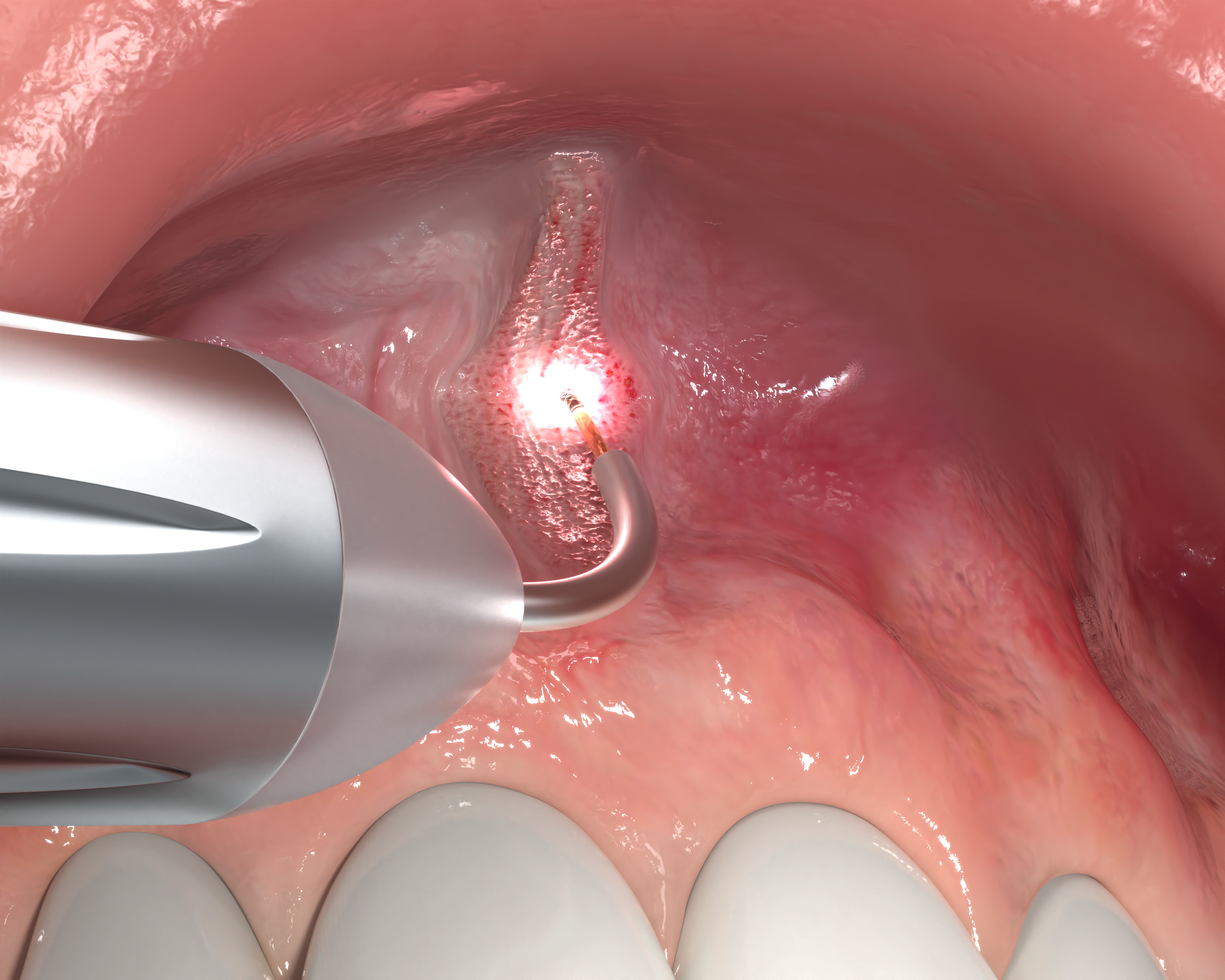 Frenectomy_Panel_5_3D_0825