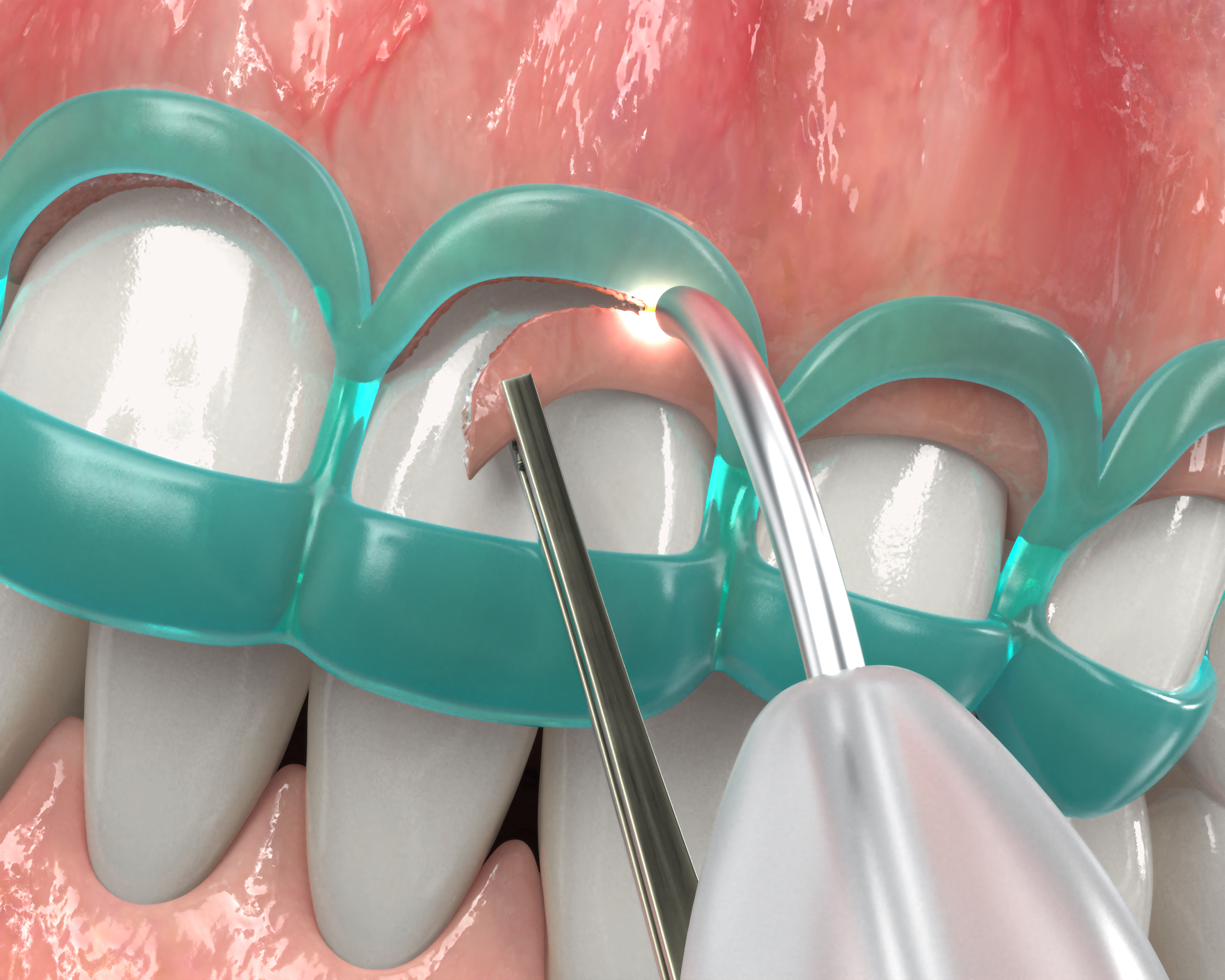Gingivectomy_Panel_3_3D_0825