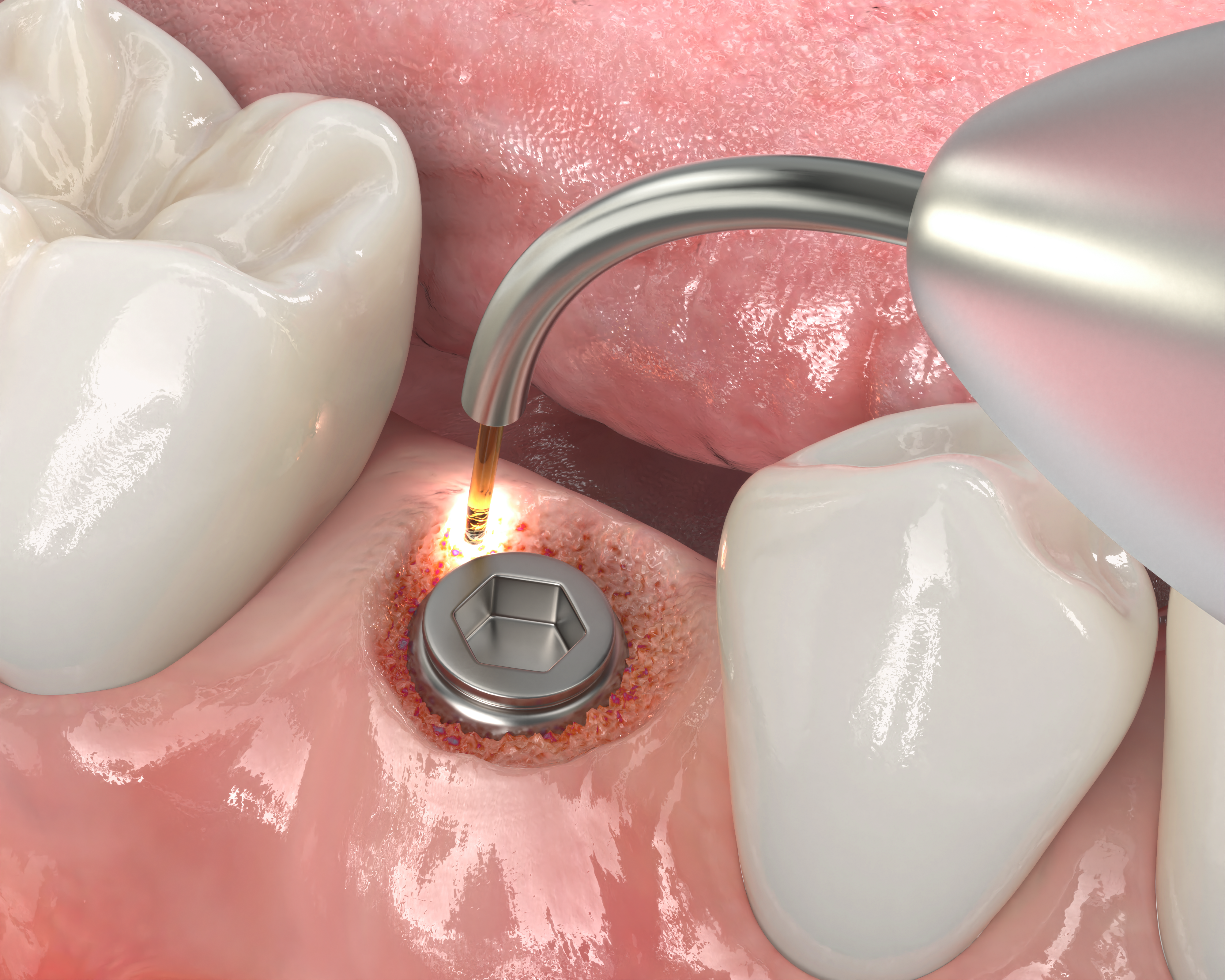 Implant_Recovery_Panel_5_3D_0825