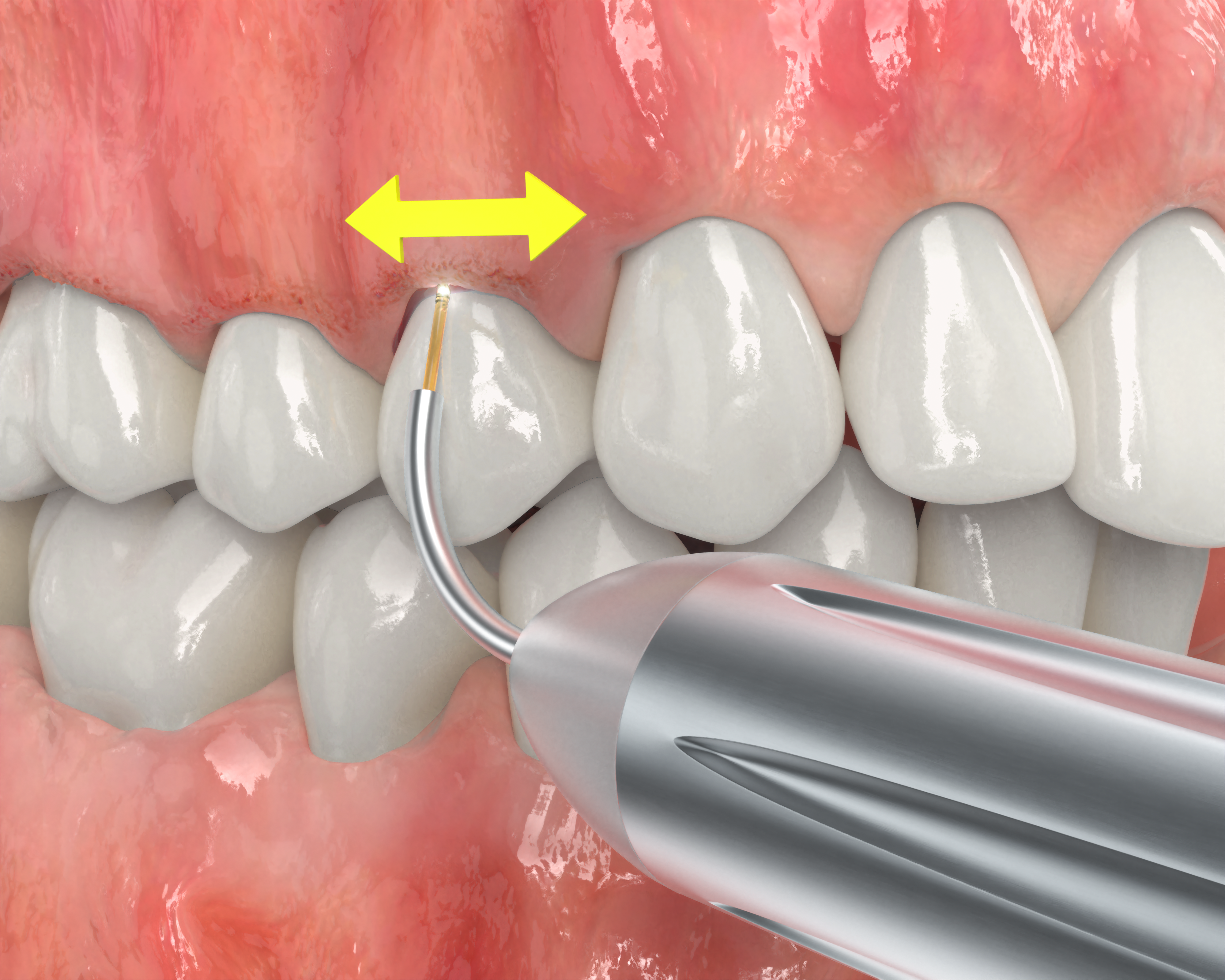 Removal_Of_Necrosis_Panel_2_3D_0725